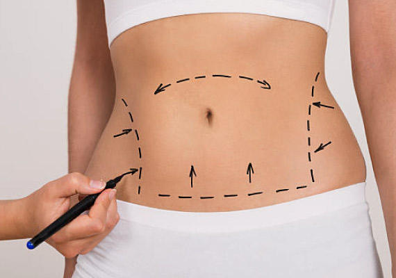 Abdominoplasty - Πλαστικός Χειρουργός Αθήνα – Μαρία Σκολαρίκου