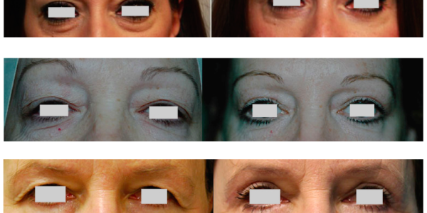 BLEPHAROPLASTY