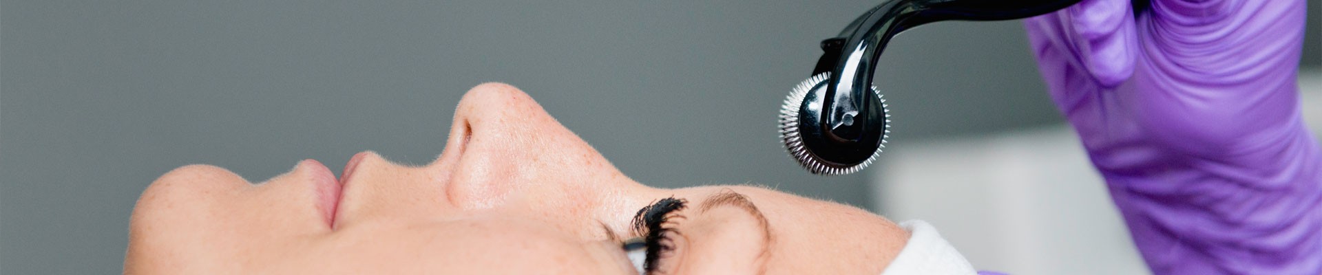 Microneedling