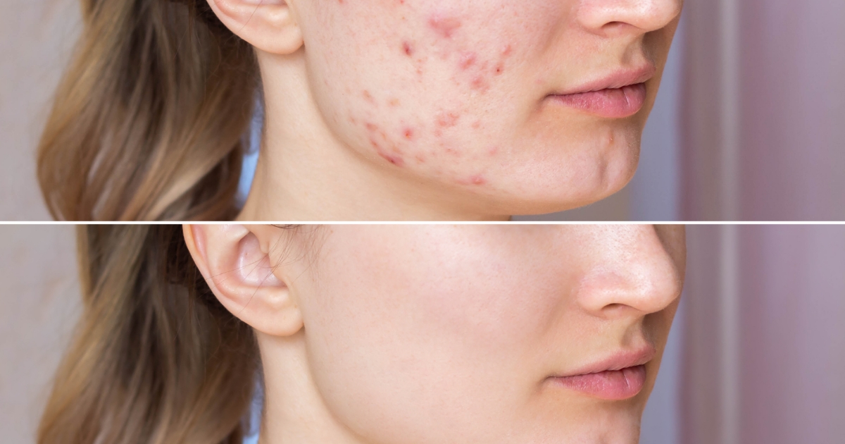 acne scars and marks