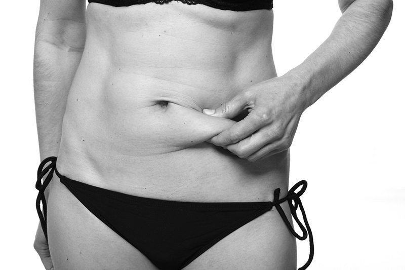 abdominoplasty