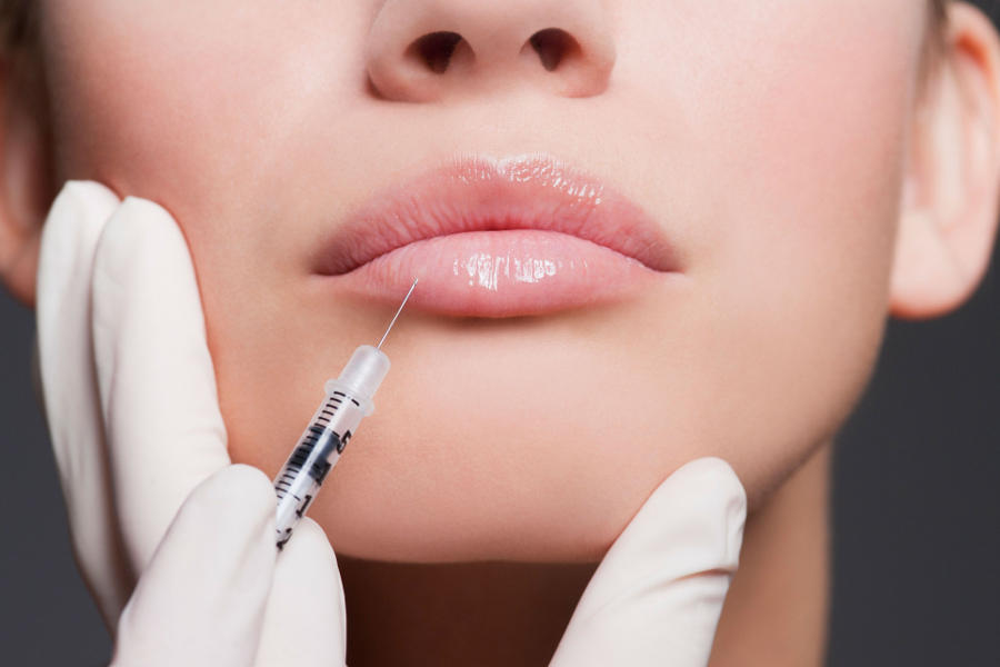 Hyaluronic acid on the lips