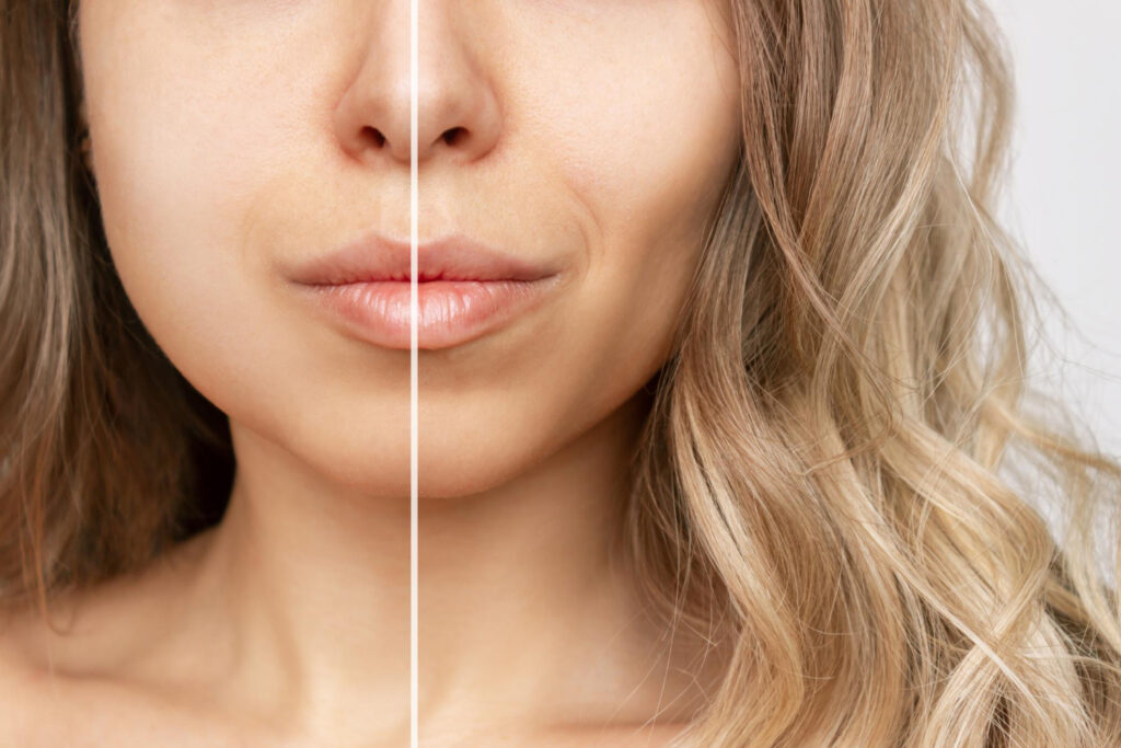 buccal fat removal