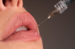 πρήξιμο μετά από υαλουρονικό στα χείλη