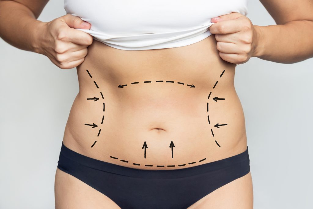 tummy tuck