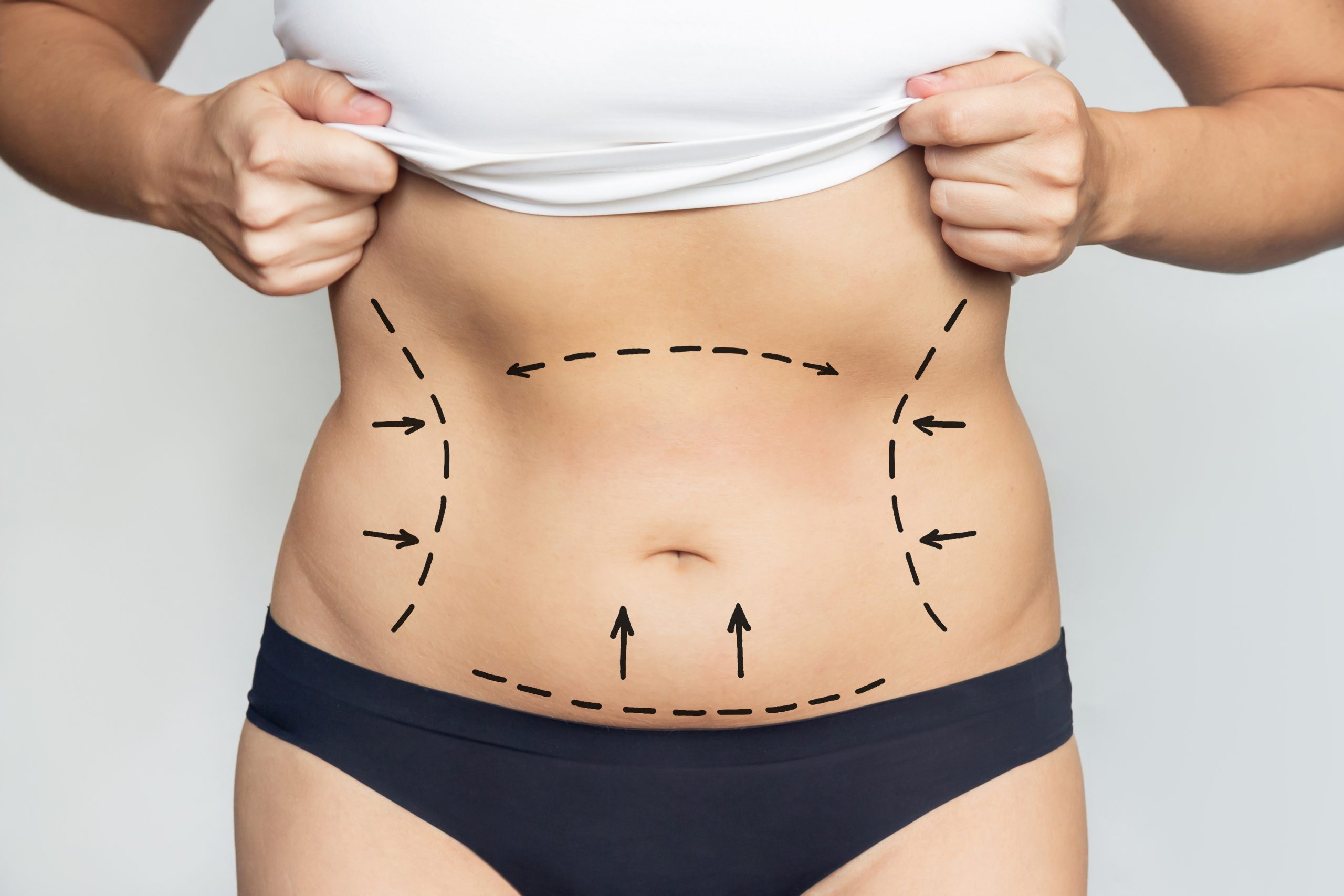 tummy tuck